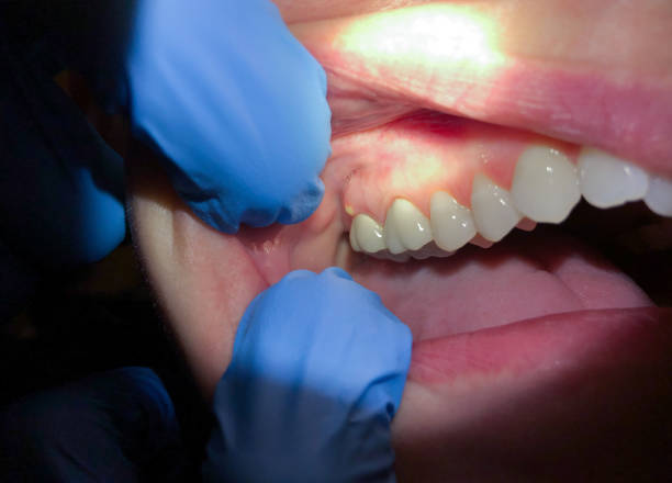 Emergency Dental Filling Replacement in OR