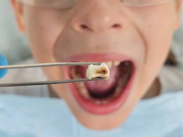 Best Chipped Tooth Repair Near Me  in Nth Bend, OR